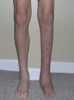 Leg Length Discrepancy
